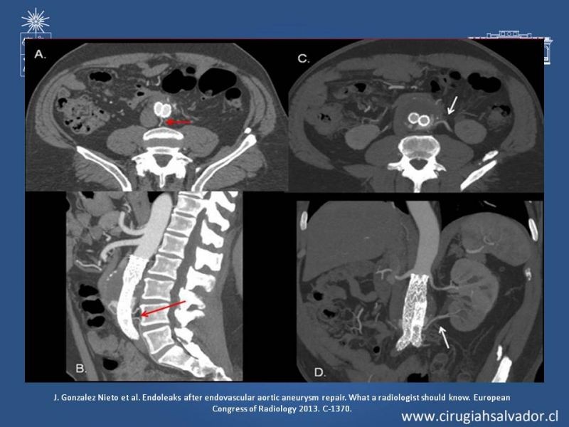 Diapositiva 21 de Endoleak post EVAR
