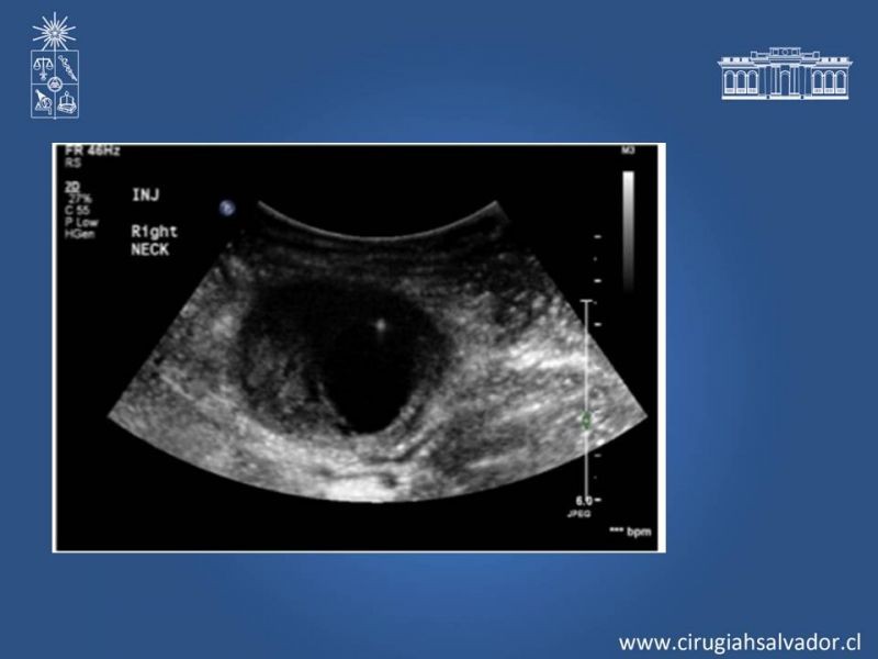Diapositiva 6 de Pseudoaneurisma Post Angiografía