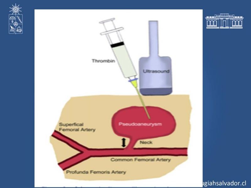 Diapositiva 14 de Pseudoaneurisma Post Angiografía