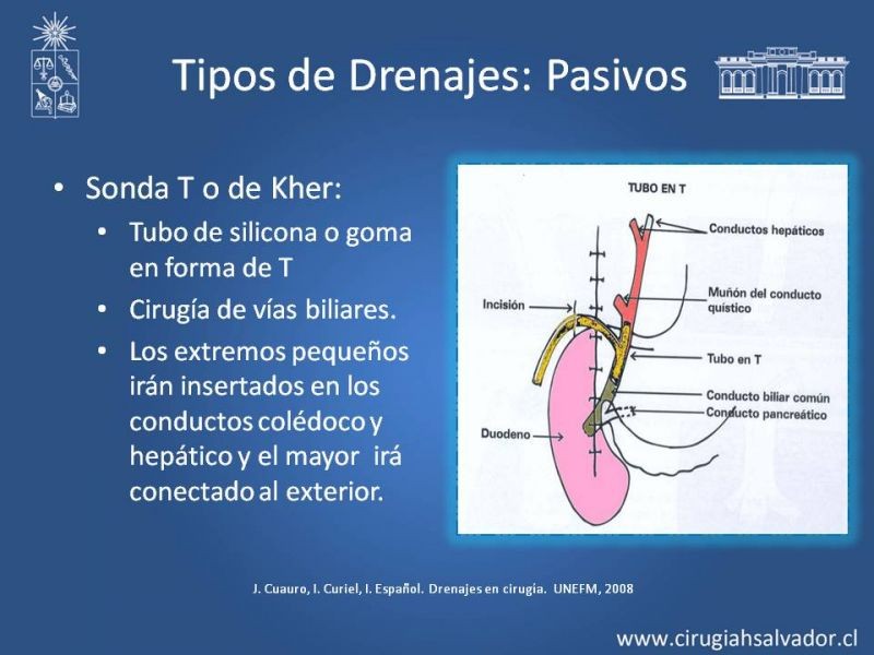 Diapositiva 19 de Drenajes: Indicación y Utilidad
