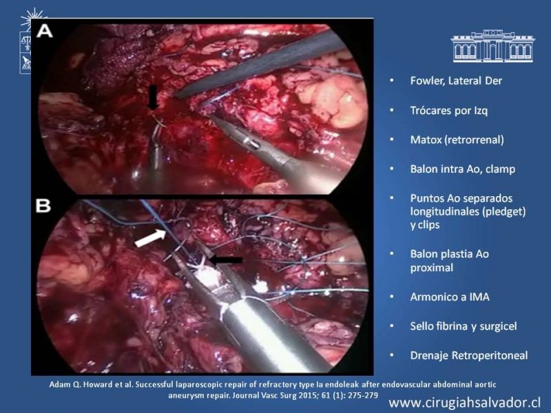 Diapositiva 18 de Endoleak post EVAR
