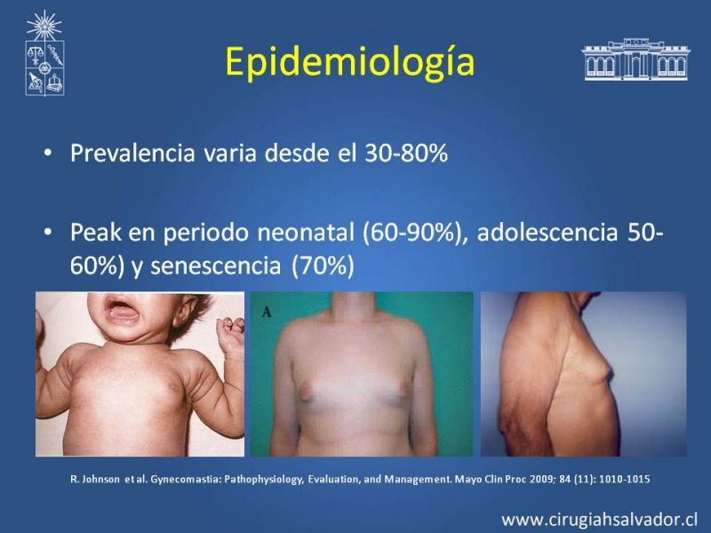 Diapositiva 2 de Ginecomastia