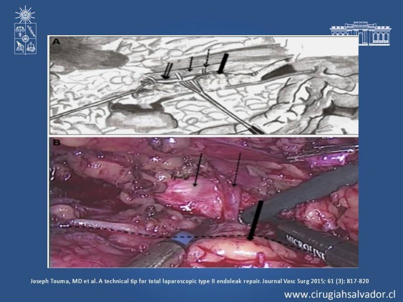 Diapositiva 34 de Endoleak post EVAR