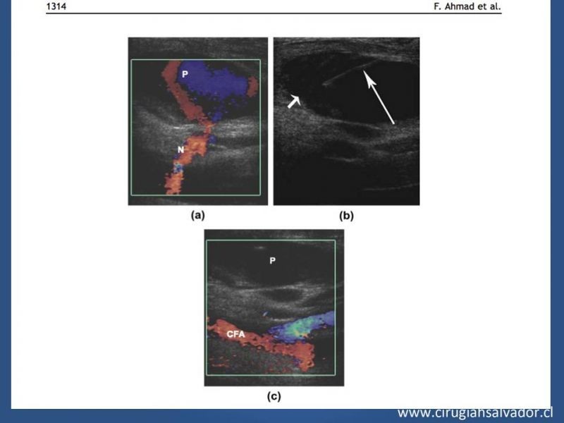 Diapositiva 15 de Pseudoaneurisma Post Angiografía