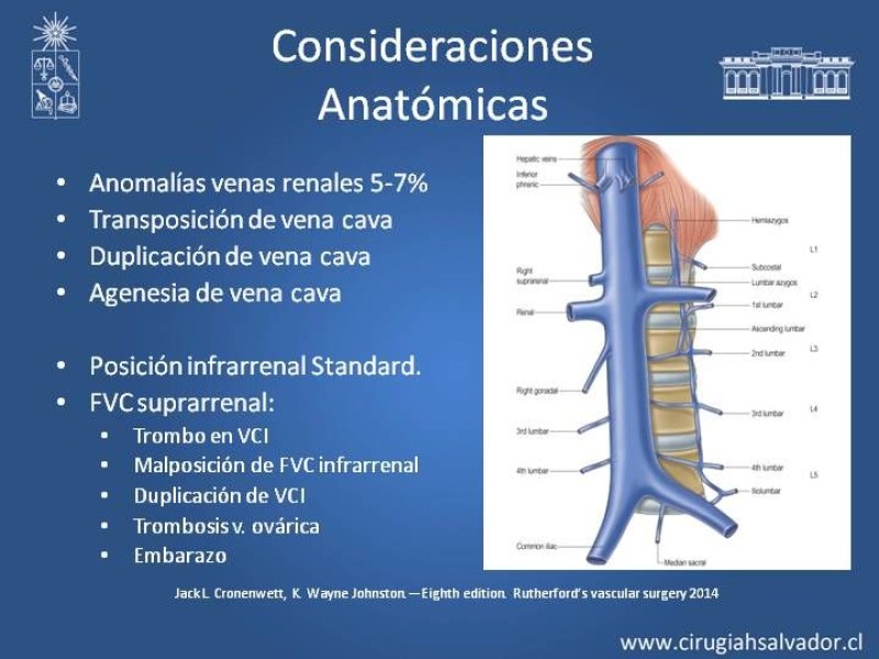 Diapositiva 13 de Filtro de Vena Cava