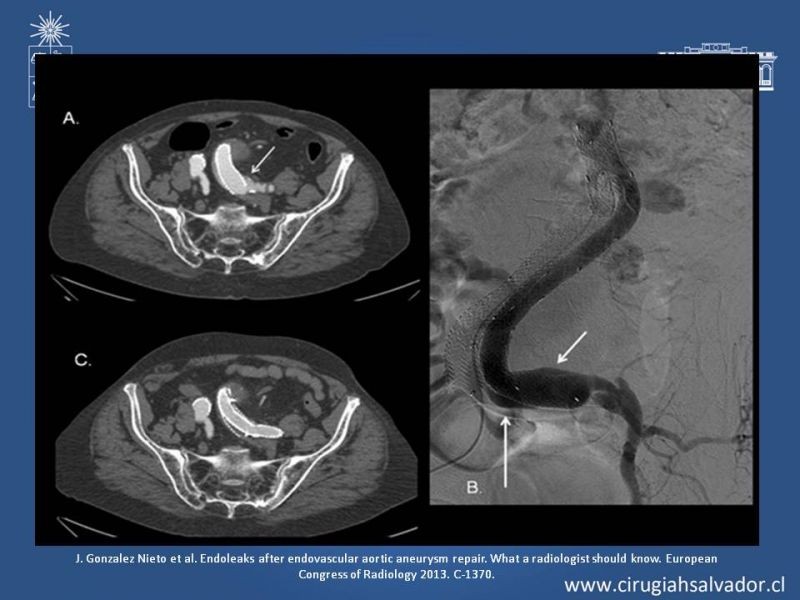 Diapositiva 14 de Endoleak post EVAR