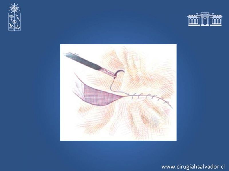 Diapositiva 11 de Hernioplastía Laparoscópica TEP vs TAPP