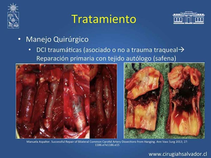 Diapositiva 18 de Disección carotidea