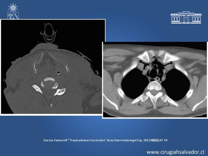 Diapositiva 5 de Trauma Cervical