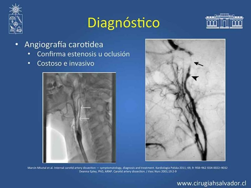 Diapositiva 10 de Disección carotidea
