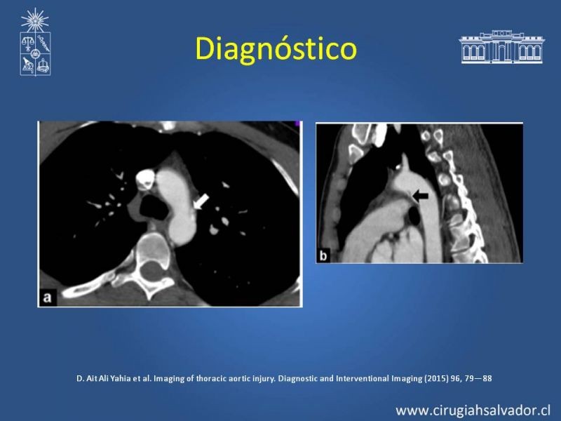 Diapositiva 7 de Trauma de Aorta Torácica