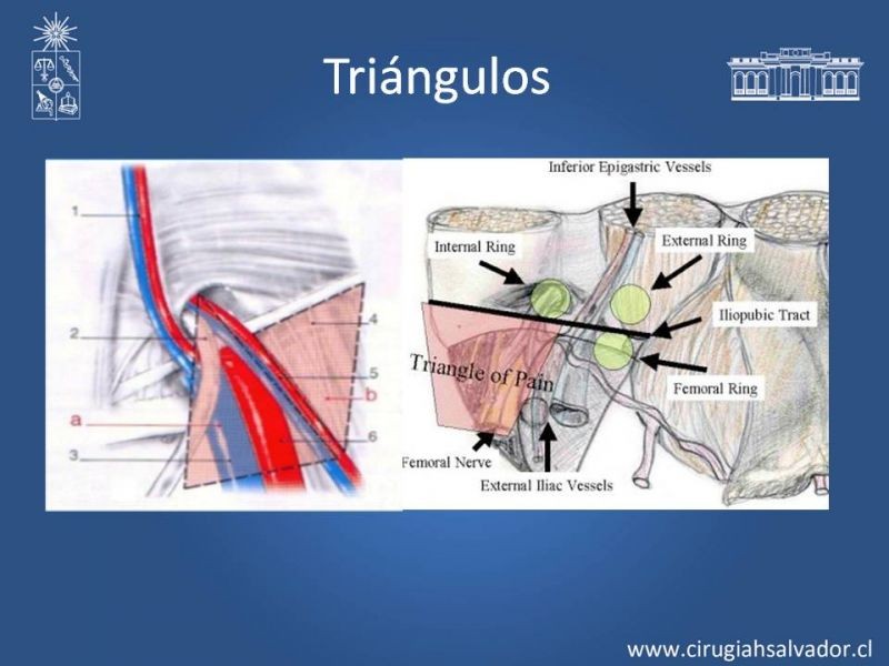 Diapositiva 5 de Hernioplastía Laparoscópica TEP vs TAPP