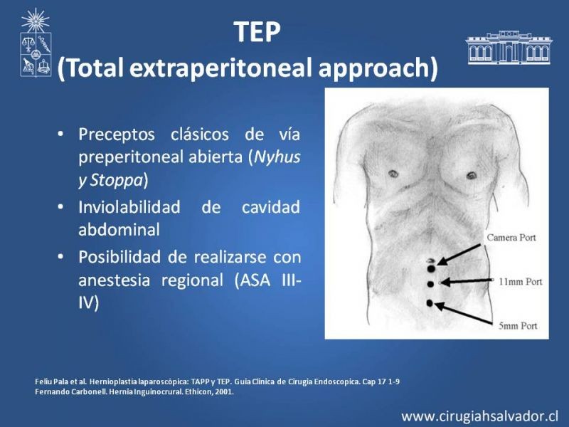 Diapositiva 6 de Hernioplastía Laparoscópica TEP vs TAPP