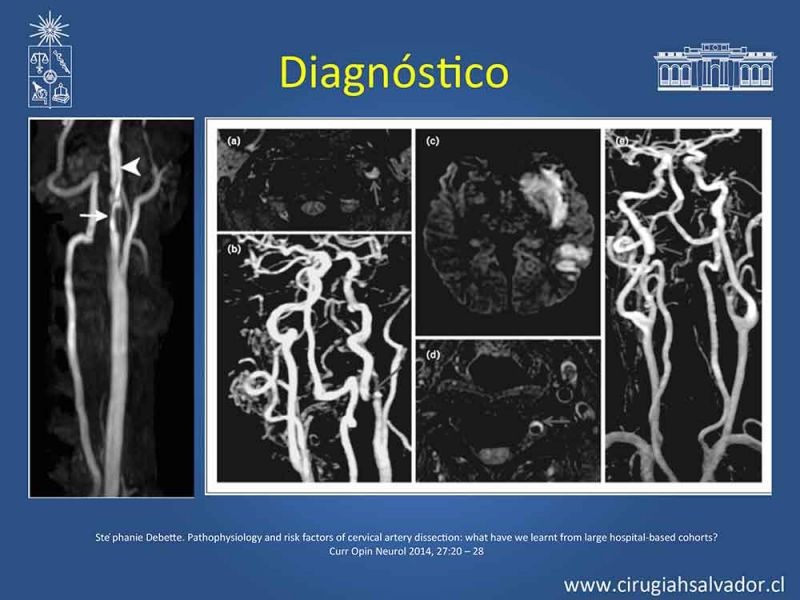Diapositiva 12 de Disección carotidea