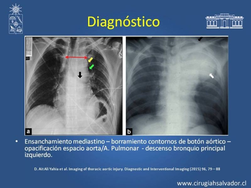 Diapositiva 5 de Trauma de Aorta Torácica