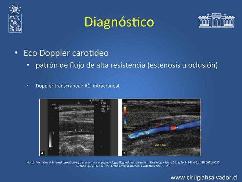 Diapositiva 9 de Disección carotidea