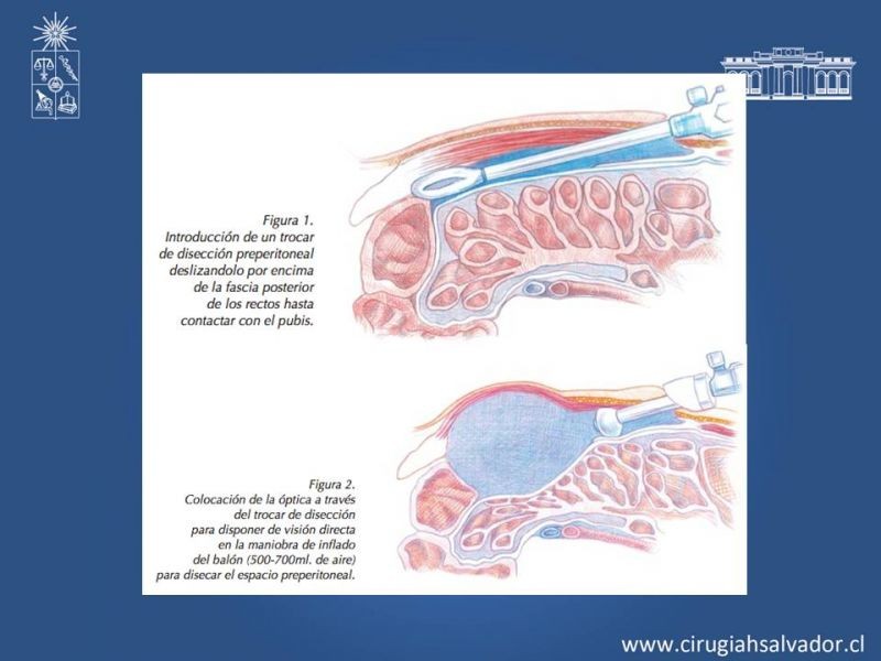Diapositiva 7 de Hernioplastía Laparoscópica TEP vs TAPP