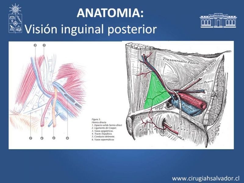 Diapositiva 4 de Hernioplastía Laparoscópica TEP vs TAPP