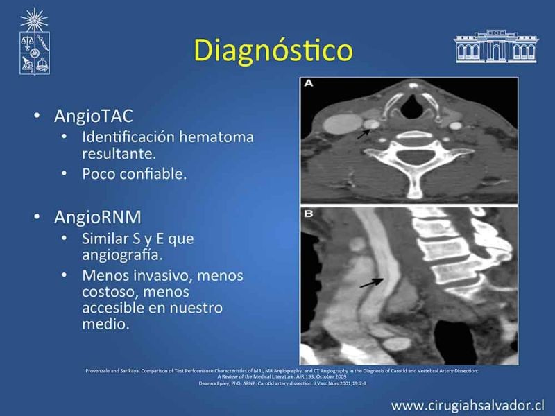 Diapositiva 11 de Disección carotidea