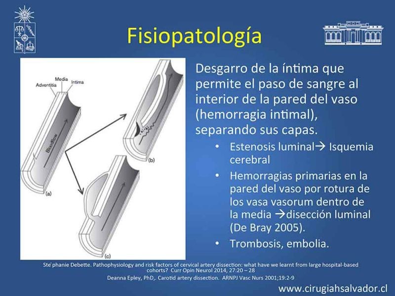 Diapositiva 4 de Disección carotidea