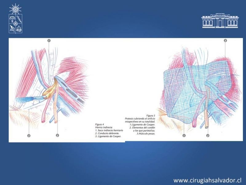 Diapositiva 8 de Hernioplastía Laparoscópica TEP vs TAPP