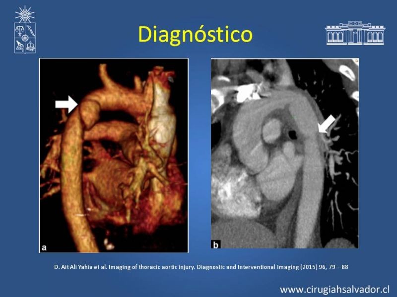 Diapositiva 8 de Trauma de Aorta Torácica