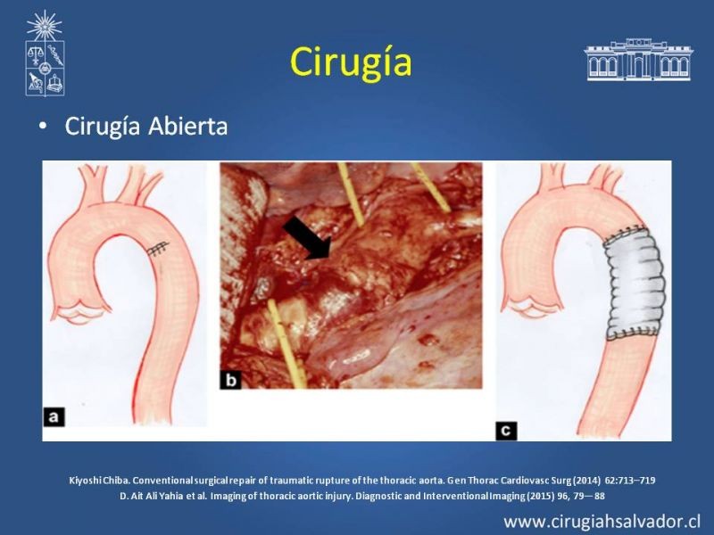 Diapositiva 15 de Trauma de Aorta Torácica