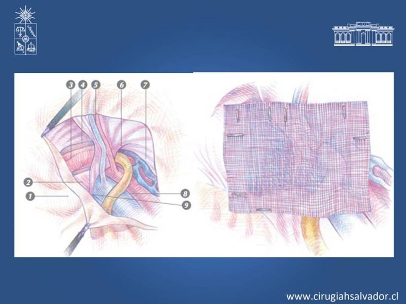 Diapositiva 10 de Hernioplastía Laparoscópica TEP vs TAPP
