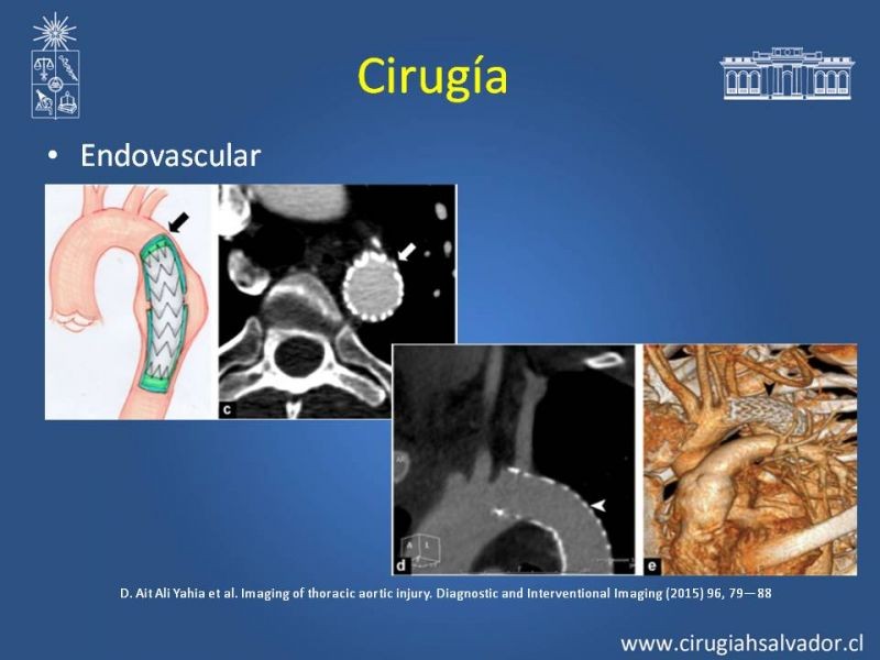 Diapositiva 17 de Trauma de Aorta Torácica