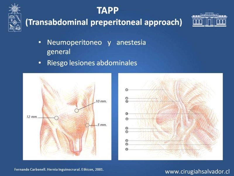 Diapositiva 9 de Hernioplastía Laparoscópica TEP vs TAPP