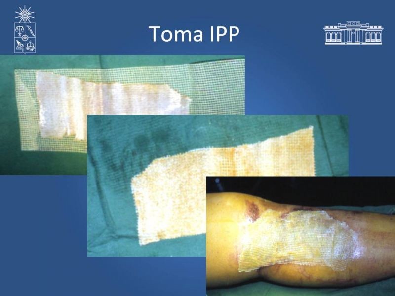 Diapositiva 21 de Injerto dermo-epidérmico: Técnica Quirúrgica 