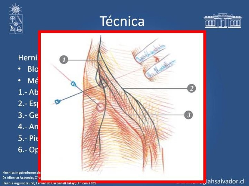 Diapositiva 13 de A. Local en la reparación de hernia Inguinal