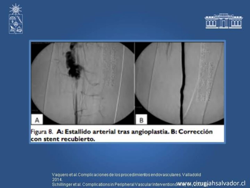 Diapositiva 15 de Complicaciones en Cirugía Endovascular