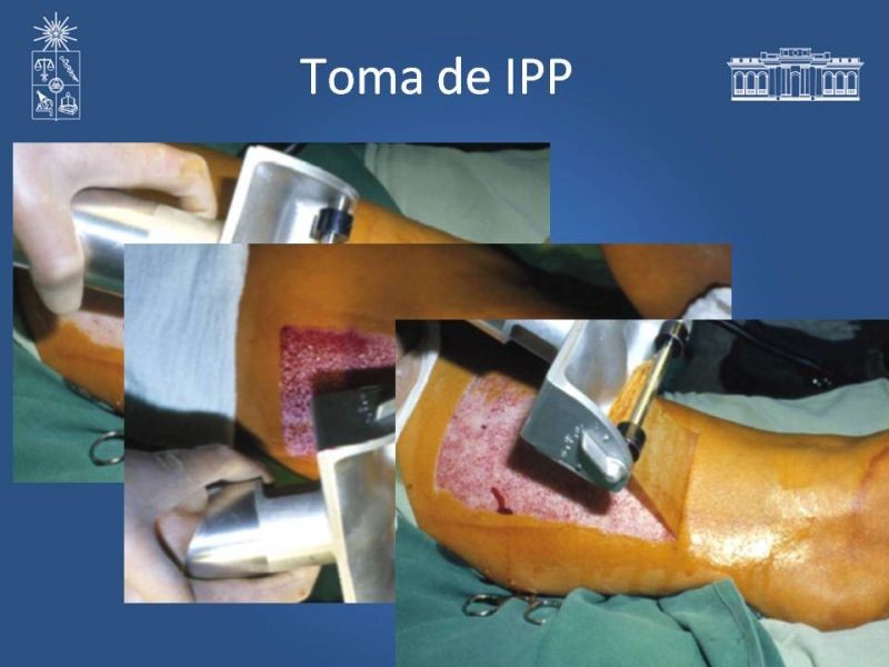 Diapositiva 19 de Injerto dermo-epidérmico: Técnica Quirúrgica 