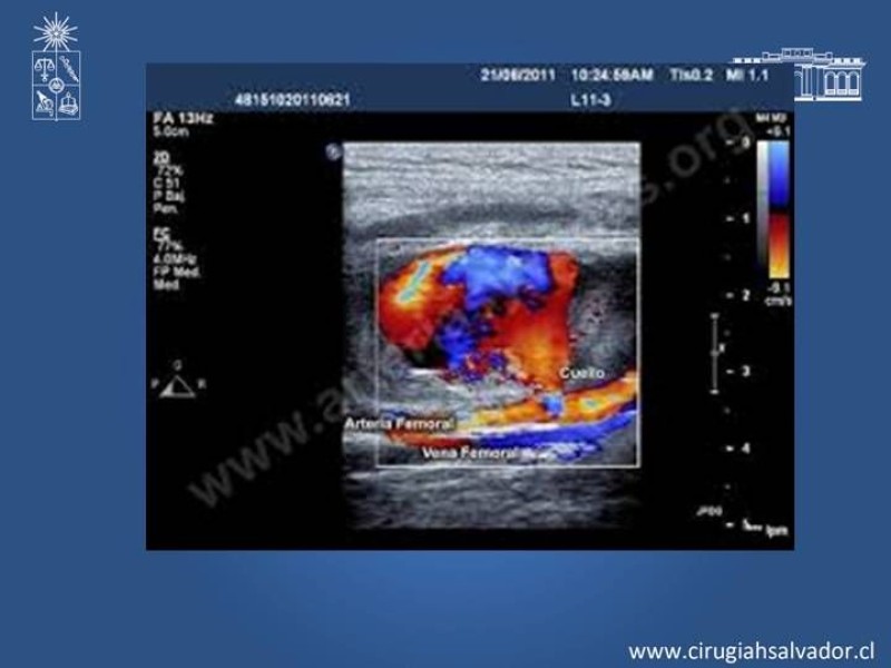 Diapositiva 7 de Complicaciones en Cirugía Endovascular