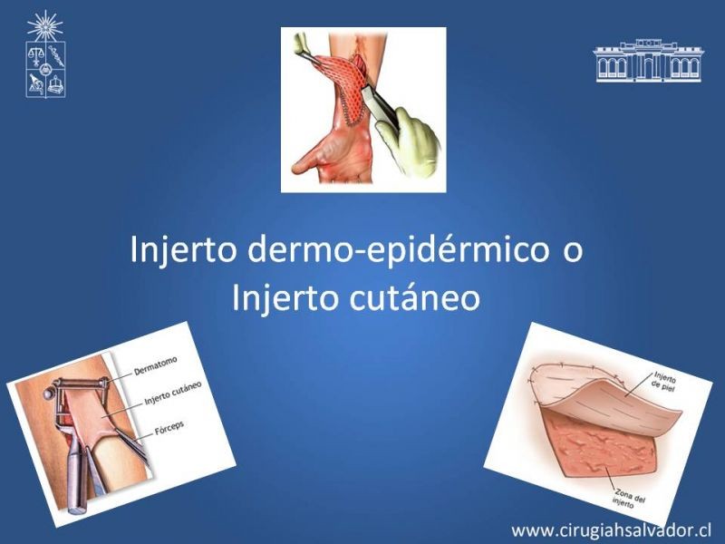 Diapositiva 6 de Injerto dermo-epidérmico: Técnica Quirúrgica 