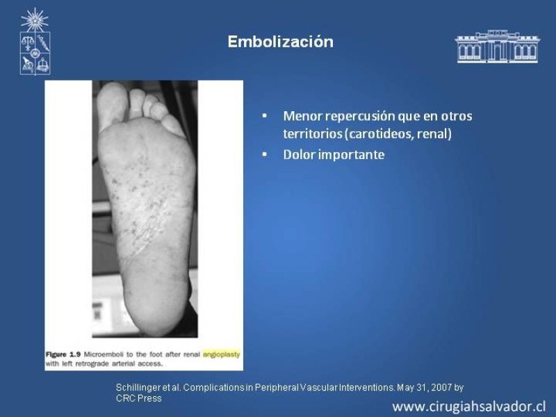 Diapositiva 16 de Complicaciones en Cirugía Endovascular