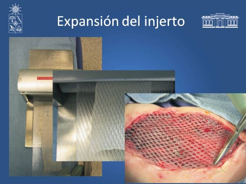 Diapositiva 35 de Injerto dermo-epidérmico: Técnica Quirúrgica 