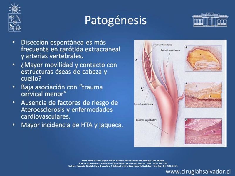 Diapositiva 4 de Disección Carotídea