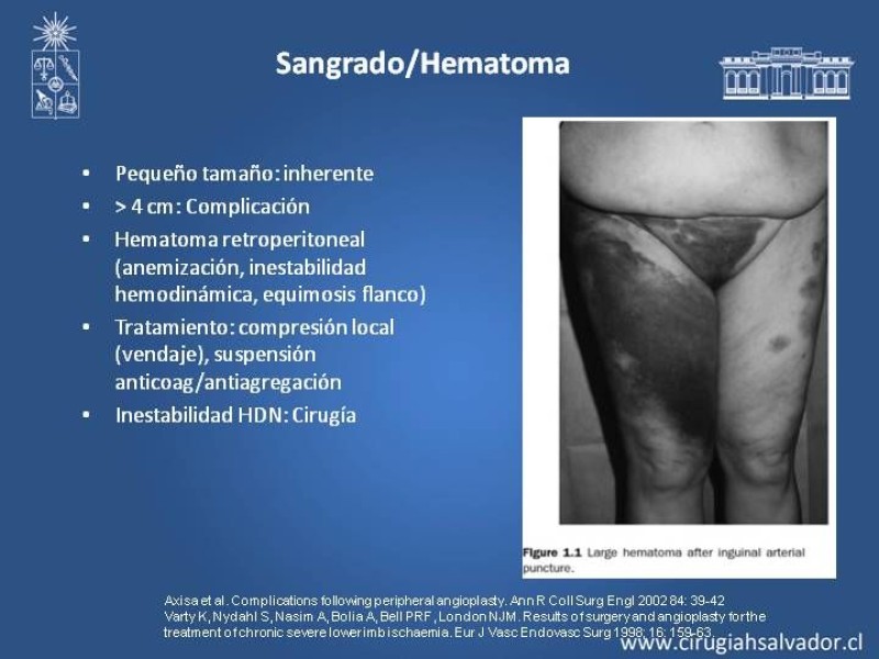 Diapositiva 5 de Complicaciones en Cirugía Endovascular