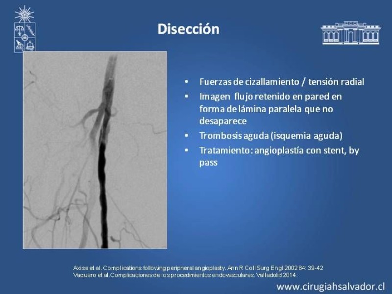 Diapositiva 13 de Complicaciones en Cirugía Endovascular