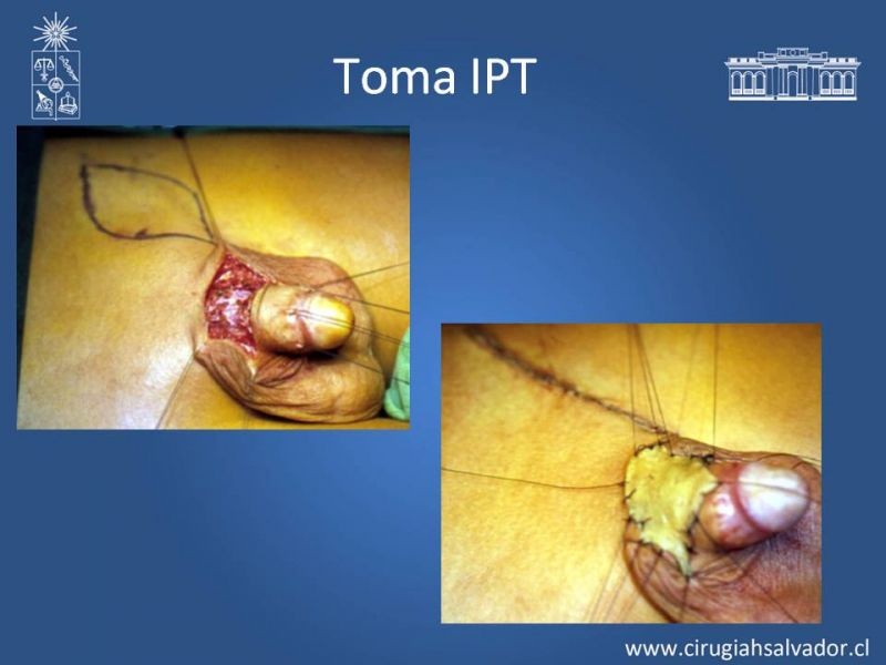 Diapositiva 22 de Injerto dermo-epidérmico: Técnica Quirúrgica 