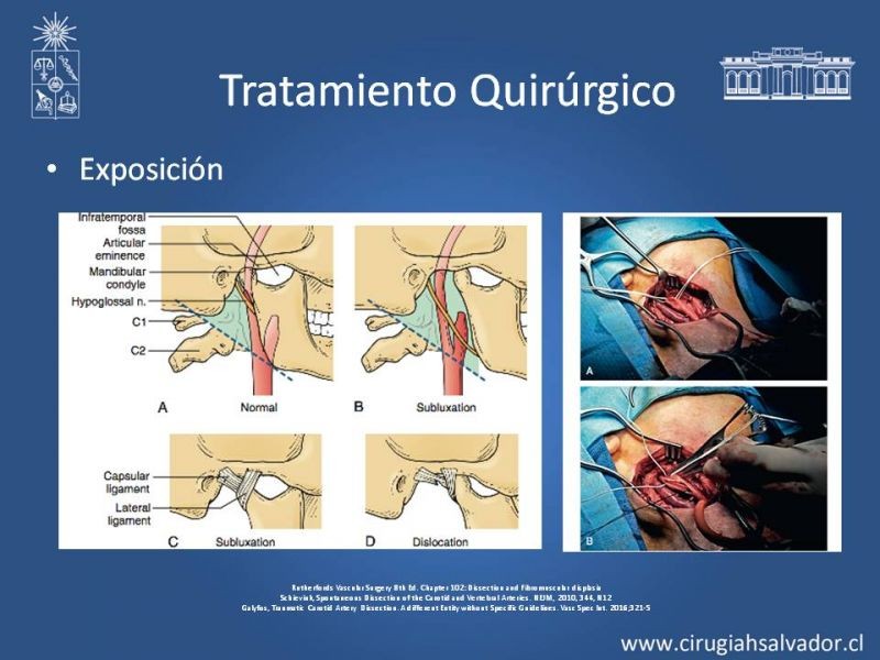 Diapositiva 17 de Disección Carotídea