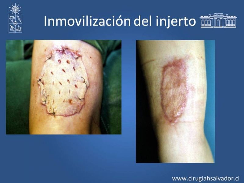 Diapositiva 27 de Injerto dermo-epidérmico: Técnica Quirúrgica 