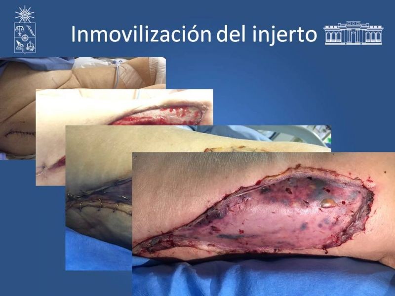 Diapositiva 28 de Injerto dermo-epidérmico: Técnica Quirúrgica 