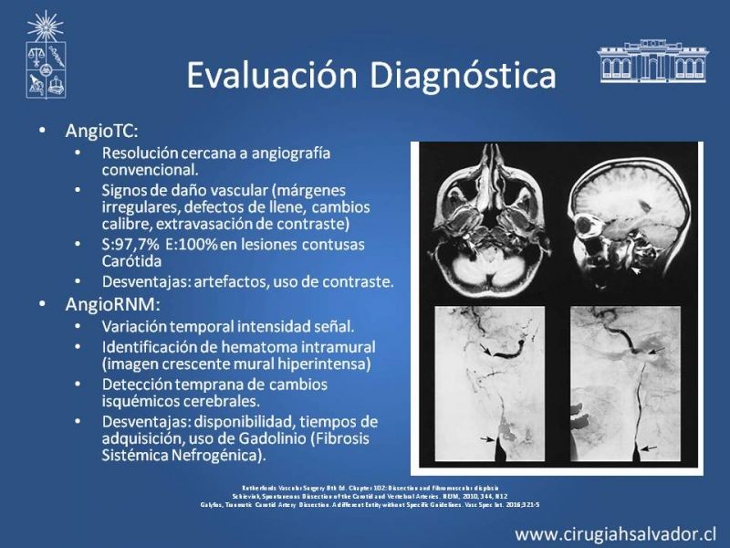Diapositiva 9 de Disección Carotídea