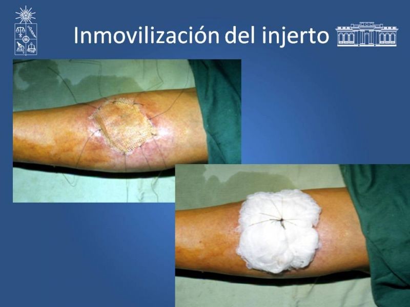 Diapositiva 26 de Injerto dermo-epidérmico: Técnica Quirúrgica 