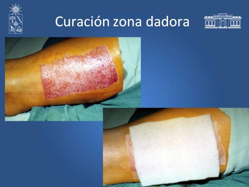 Diapositiva 30 de Injerto dermo-epidérmico: Técnica Quirúrgica 
