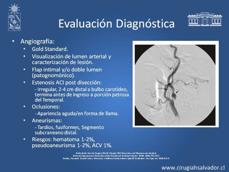 Diapositiva 11 de Disección Carotídea
