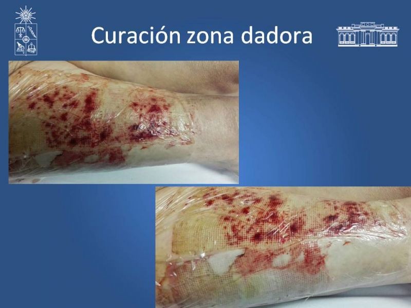 Diapositiva 31 de Injerto dermo-epidérmico: Técnica Quirúrgica 